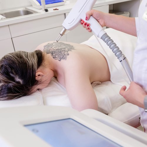 Top view hand of a beautician holds a laser device over a tattooed back of a girl to remove an unwanted tattoo. Concept of erasing tattoos as expensive procedure in beauty parlor modern vedical clinic