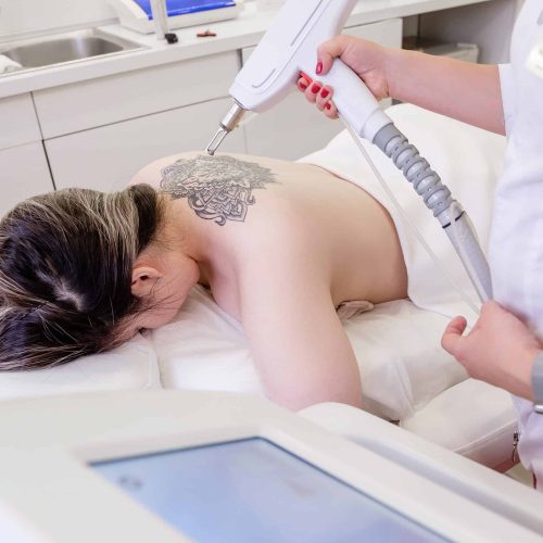 Top view hand of a beautician holds a laser device over a tattooed back of a girl to remove an unwanted tattoo. Concept of erasing tattoos as expensive procedure in beauty parlor modern vedical clinic